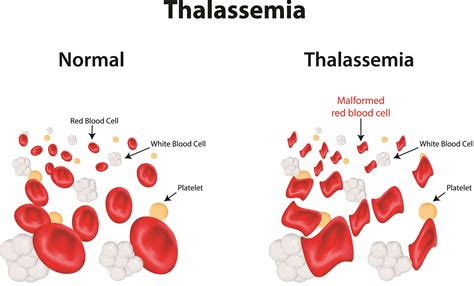 Many times people with thalassemia are prescribed a supplemental B vitamin, known as folic acid, to help treat anemia. . Thalassemia minor and pregnancy